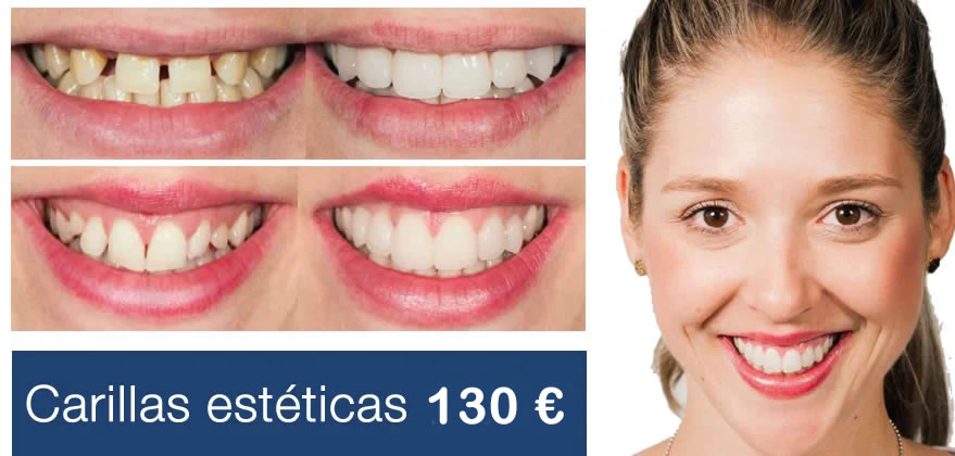 oferta carillas esteticas Oferta de carillas estéticas en Fuengirola Mijas